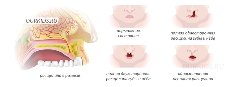 виды нёбных расщелин виды нёбных расщелин