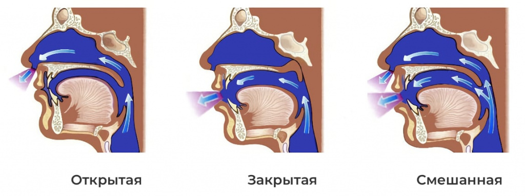 Виды ринолалии Виды ринолалии