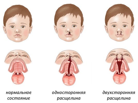 Расщелины при ринолалии Расщелины при ринолалии